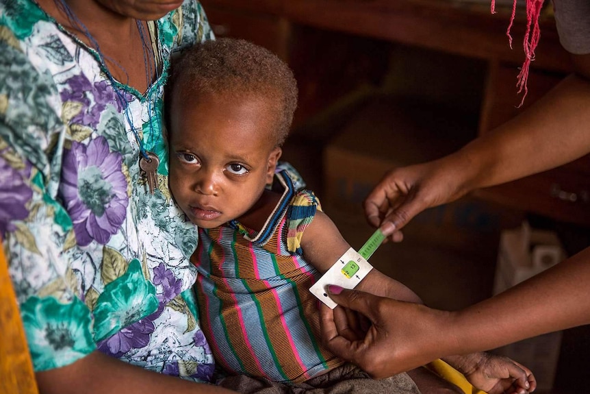 A boy receiving medical treatment for malnutrition in Ethiopia