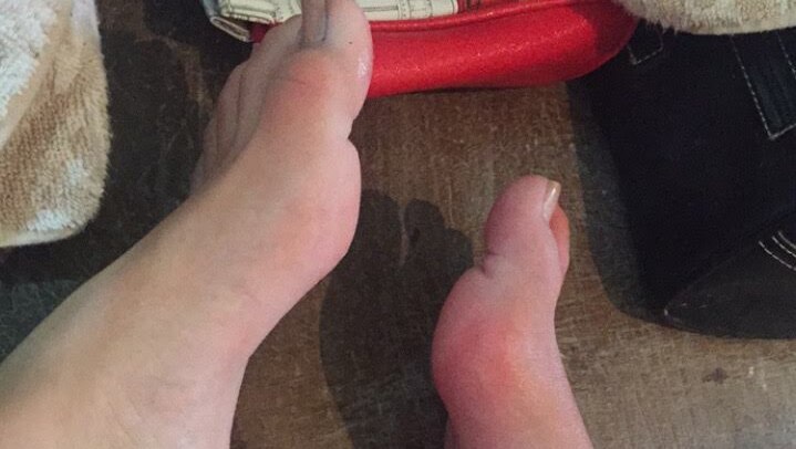 The feet of Stella Artuso, who suffers from Complex Regional Pain Syndrome.