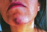 A woman with a red mark on her chin