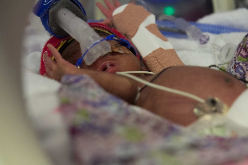 A premature baby breathes using a ventilator