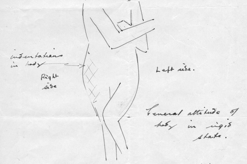 A drawing of a woman's body with a criss-cross pattern near one thigh.