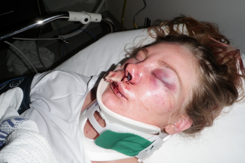 A woman lies in a hospital bed with swollen eyes and a bloodied nose.