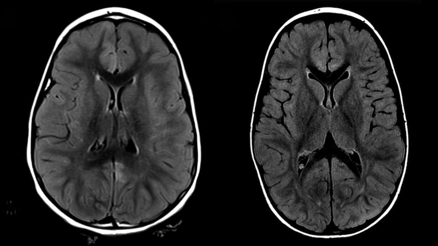 a brain mri of two seperate brains