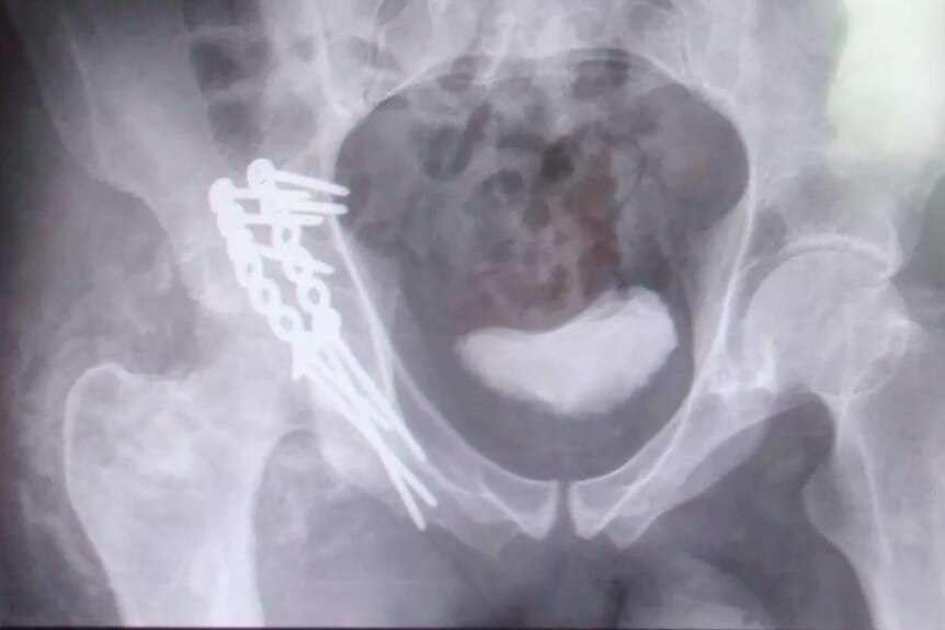 A black and white xray showing metal pins in a man's hip