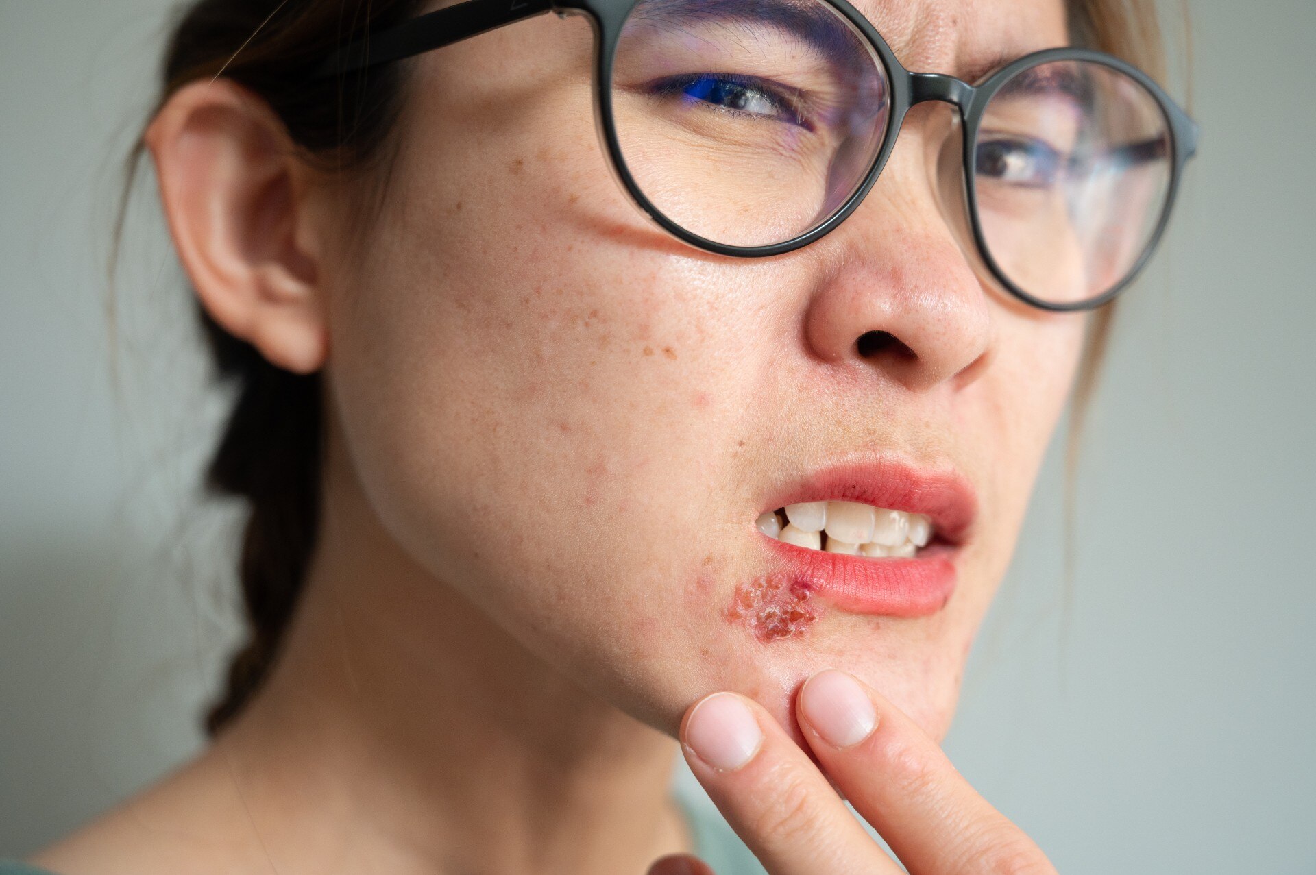 A woman with glasses and a small, scabby sore on her lower lip