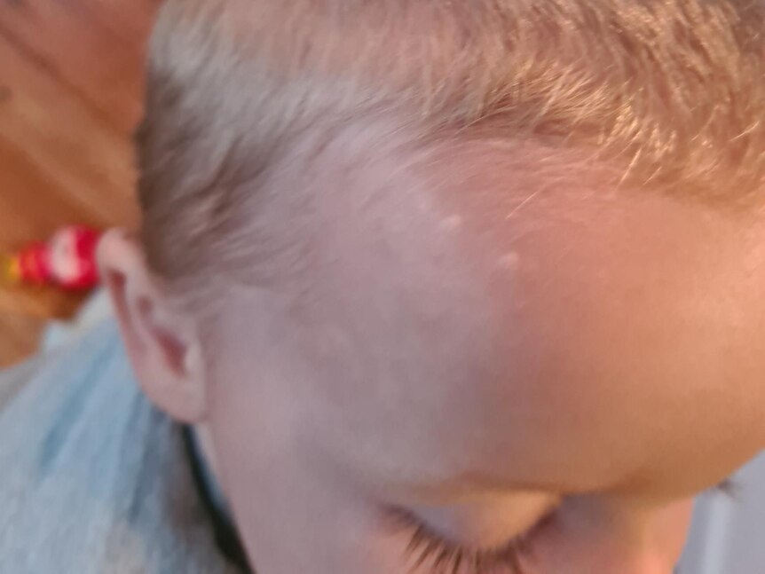 A 10-month-old baby with two small oval shaped scars side-by-side on his head.