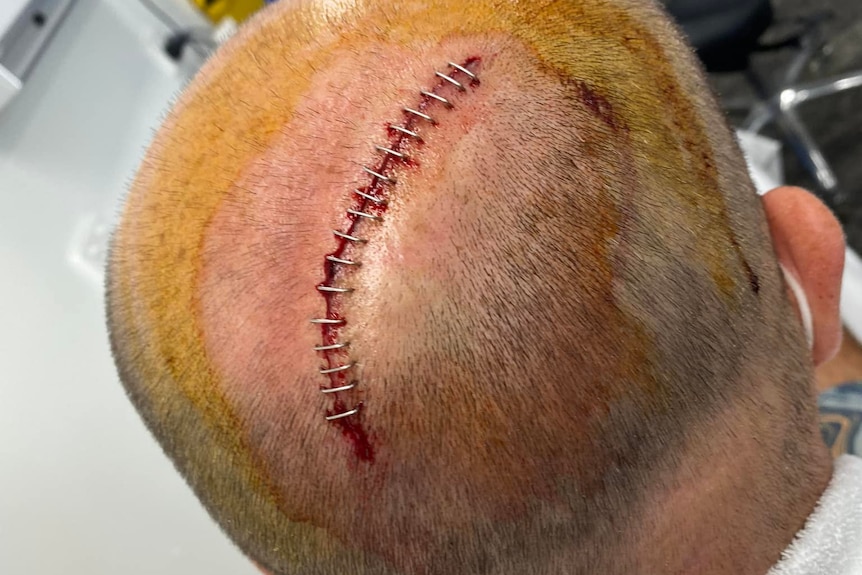 The back of a man's head with 16 staples 