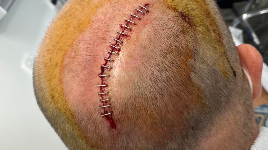 The back of a man's head with 17 staples 