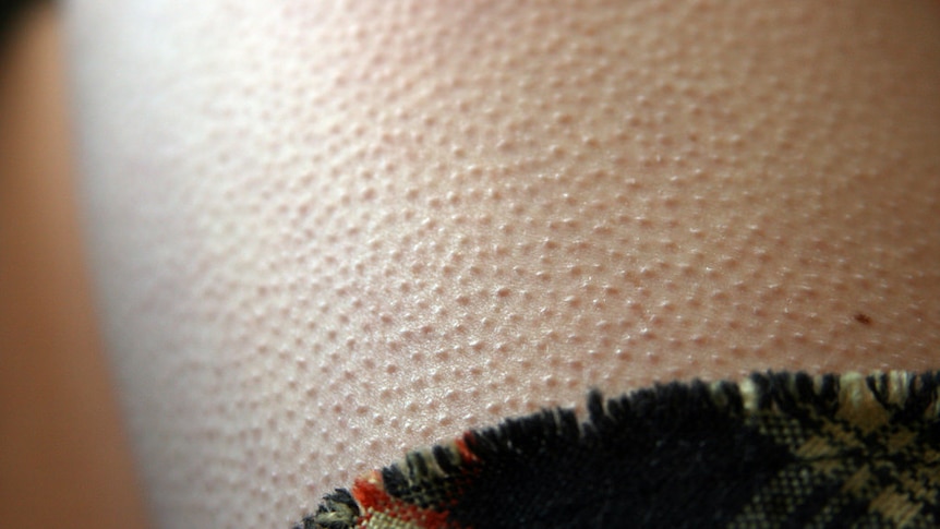 A leg covered in goosebumps