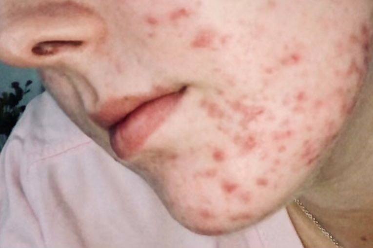 A woman's face with red pimples all over it