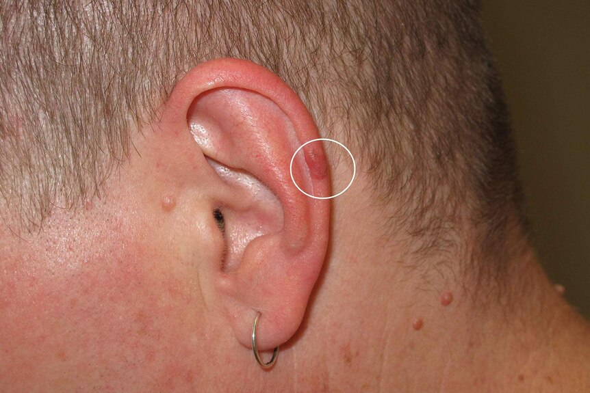 A skin lesion on a man's ear
