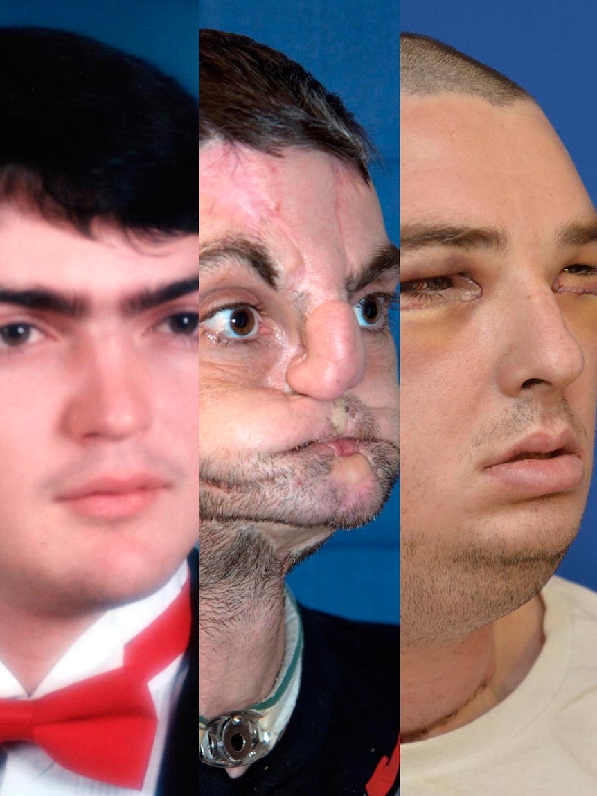 LtoR Richard Norris on his prom day, pre-face transplant surgery and post-face transplant surgery.
