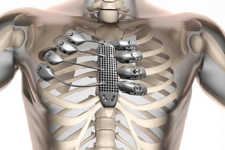 3D-printed rib cage and sternum