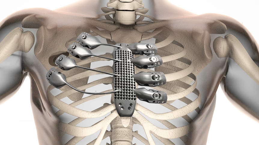 3D-printed rib cage and sternum