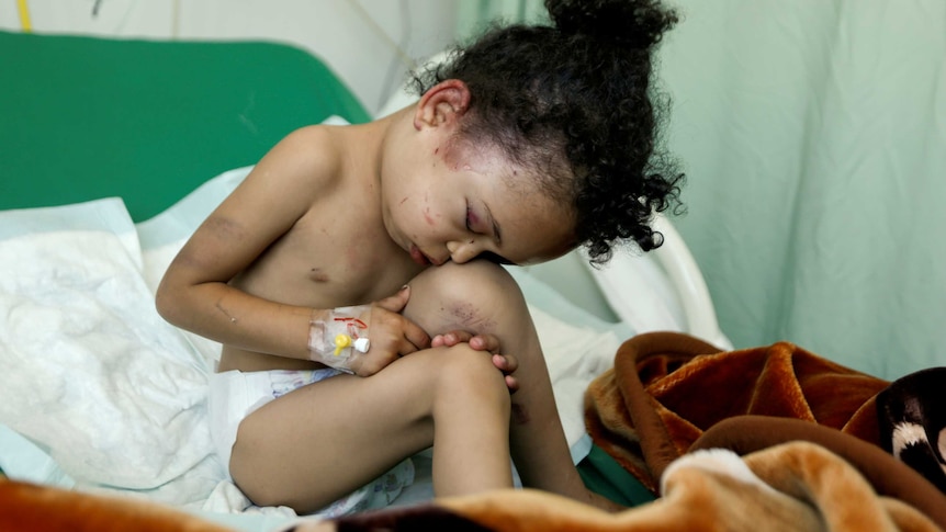 A young girl, injured in an air strike in Yemen, sits on a hospital bed with her face on her knee.