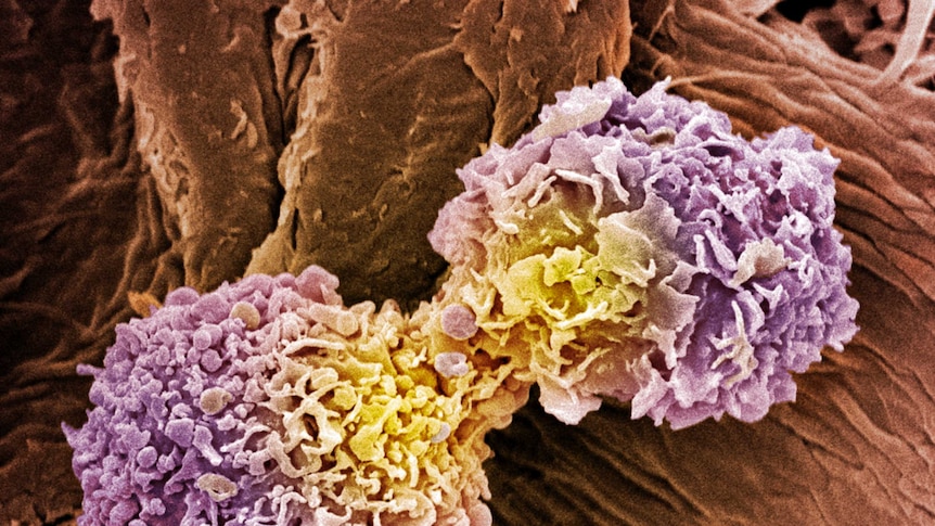 Breast cancer cells