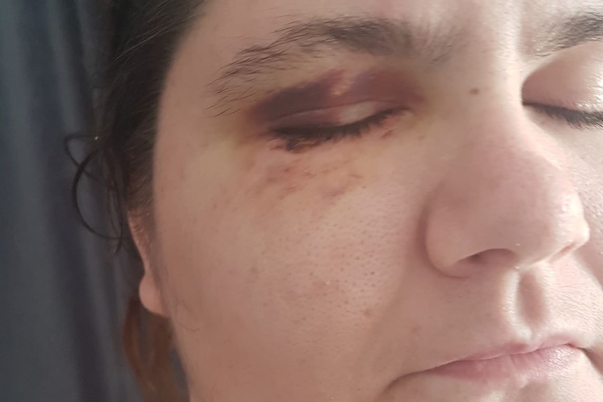 A woman has a black eye