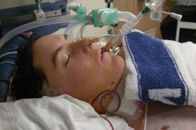A brunette man laying in a hospital bed with a clear plastic pipe coming out of his mouth