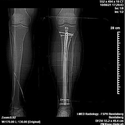 Une radiographie d'une récupération de jambe cassée 