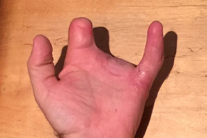 Andrew Armstrong cut off four fingers with a drop saw.