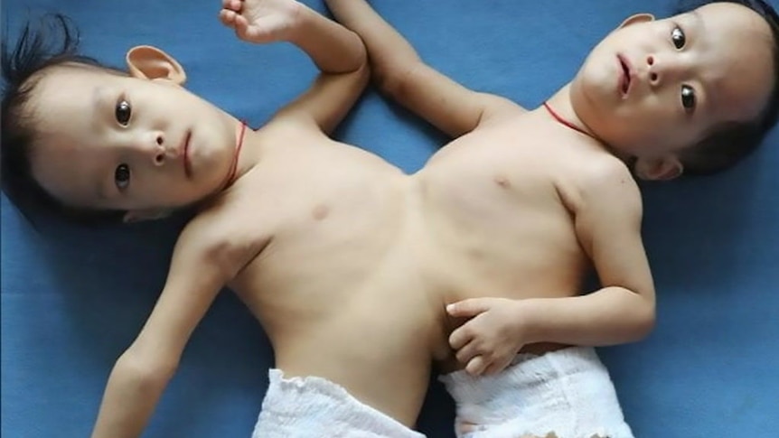 Surgeon Joe Crameri said he is 'excited' to separate the conjoined twins.