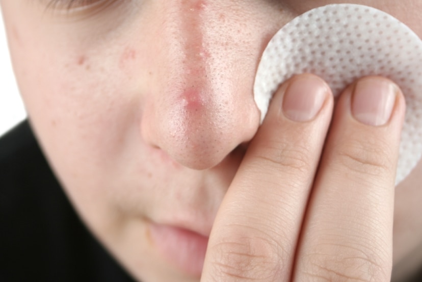 A close up shot of a male with pimples.