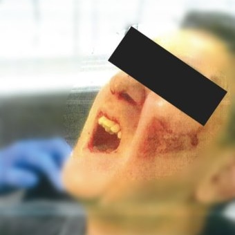 A man with injuries on his face screams in pain.