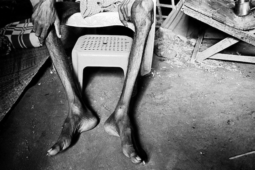 The severely malnourished legs of a sick Rohingya man sitting on a plastic chair in a camp for internally displaced persons.