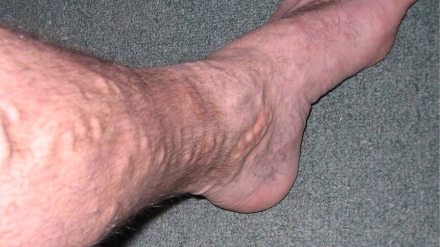 Varicose veins on the leg of a 49-year-old man.