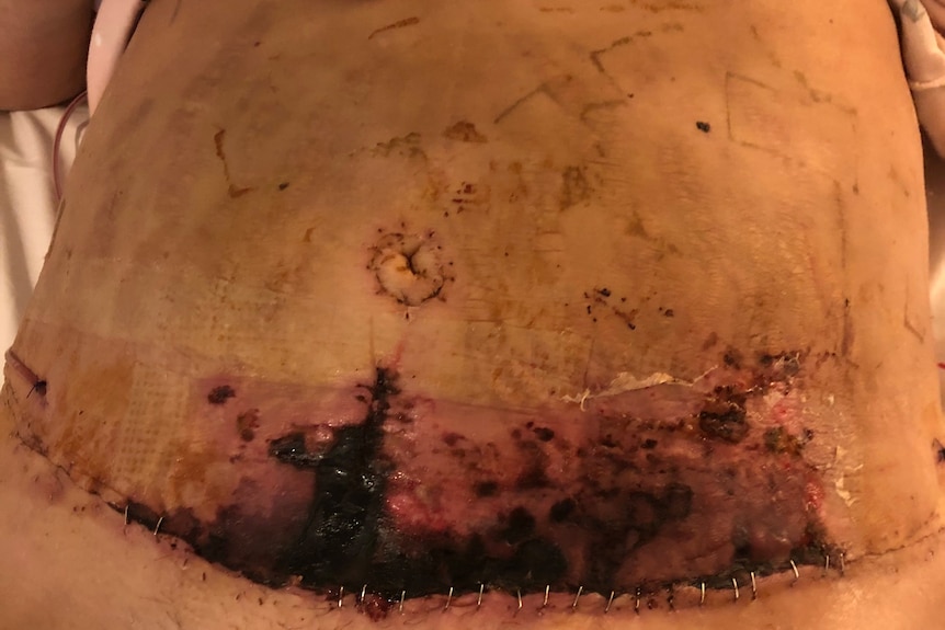 Black and red patches surround a stapled-together wound across a woman's stomach.
