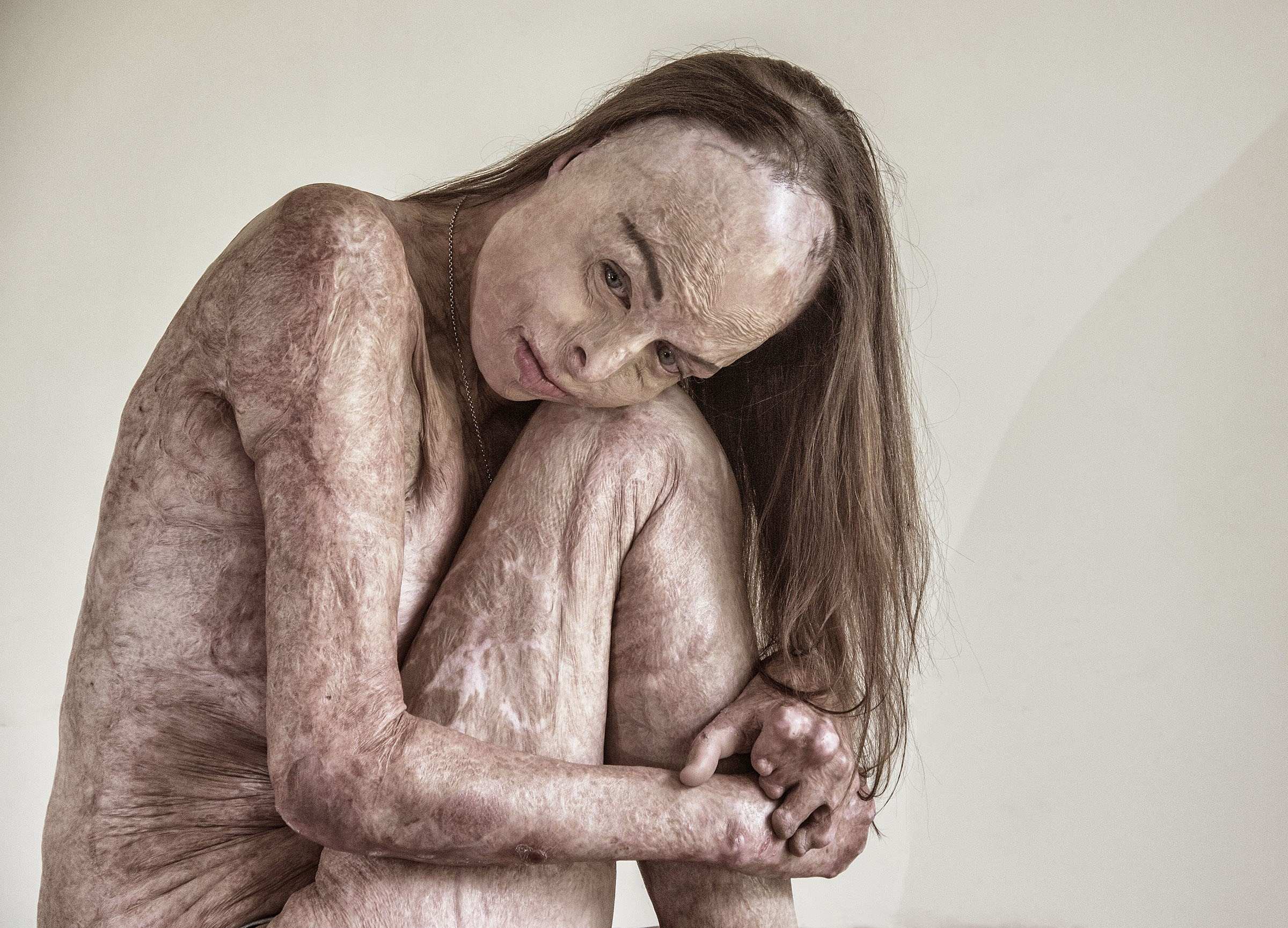 Nude woman with skin covered in scarring from being burned