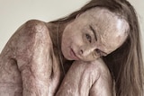 Nude woman with skin covered in scarring from being burned