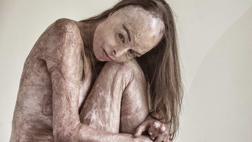 Nude woman with skin covered in scarring from being burned