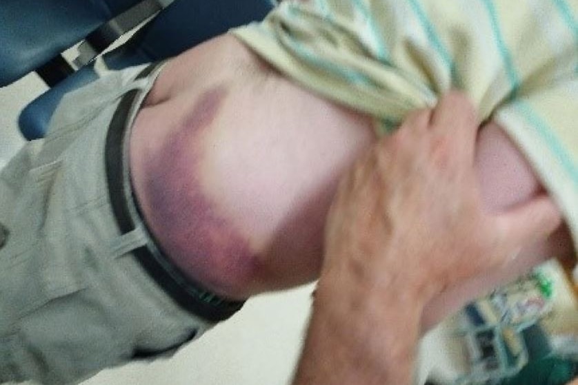 Bruising on man's lower back.