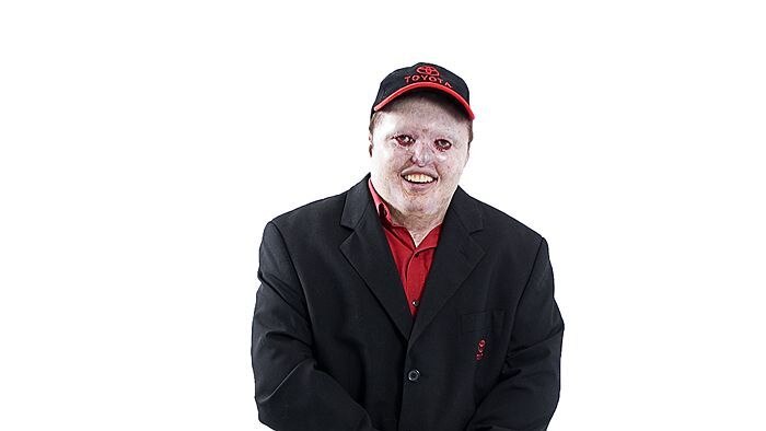 'Cotton wool kid': how Dean Clifford defied his rare skin condition episode artwork
