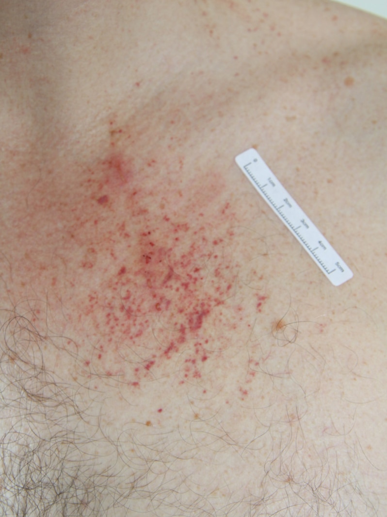A photo shows injuries to the chest of accused murderer Gerard Baden-Clay