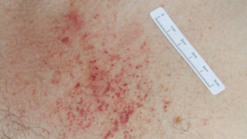 A photo shows injuries to the chest of accused murderer Gerard Baden-Clay