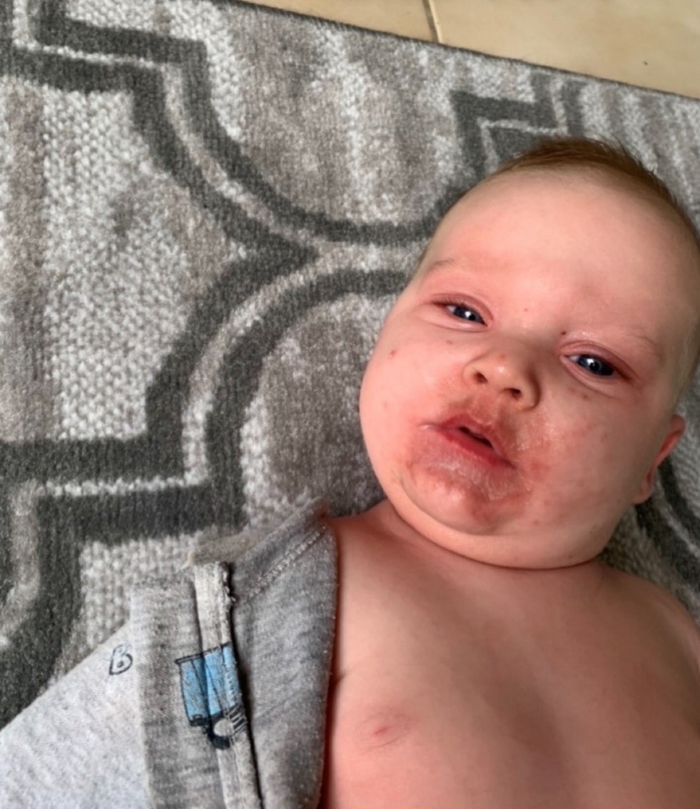 Baby Jarrod at time of third visit to Caboolture hospital in October 2022. The child has a rash around his mouth and face