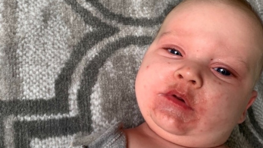 Baby Jarrod at time of second visit to Caboolture hospital in October 2022. The child has a rash around his mouth and face
