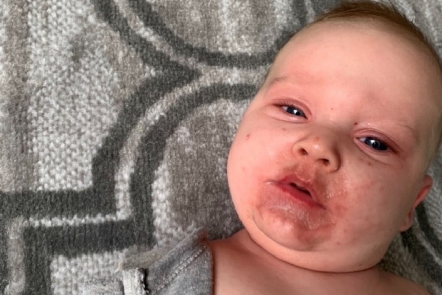 Baby Jarrod at time of third visit to Caboolture hospital in October 2022. The child has a rash around his mouth and face