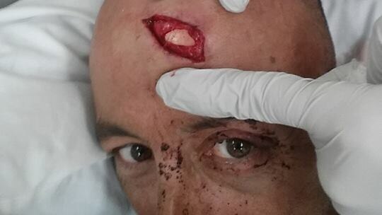 A-One Fishing Charter skipper Oliver Galea suffered a major gash to his head when a whale hit their chartered fishing boat.