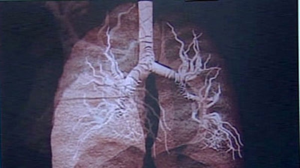 Experiments found stimulating the receptors in the lungs with bitter substances decreased airway obstruction.