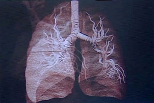Lung cancer test