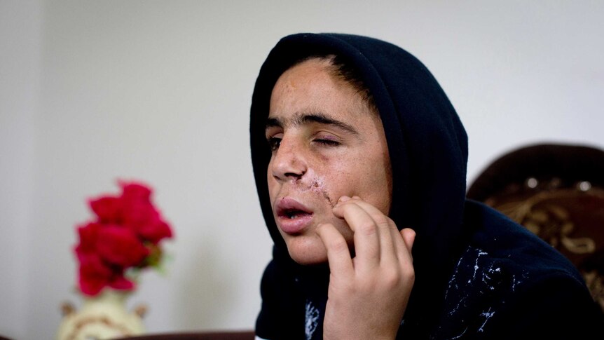 Close shot of a boy with an injured eye wearing a hoodie.