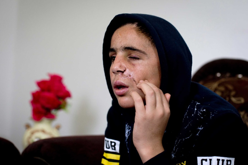 Close shot of a boy with an injured eye wearing a hoodie.