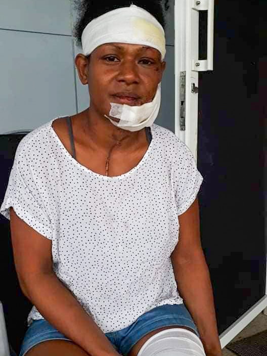 A young Papua New Guinean woman with a bandaged head, face and thigh