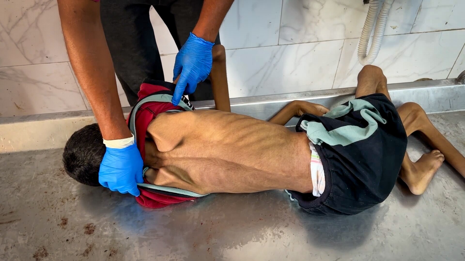 A boy lying on a bench, his back to the camera showing him clearly emaciated.