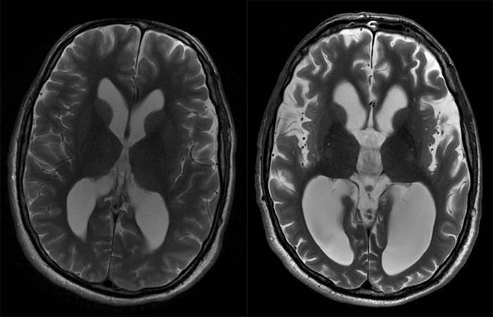 MRI scans taken three years apart showing loss of brain cells
