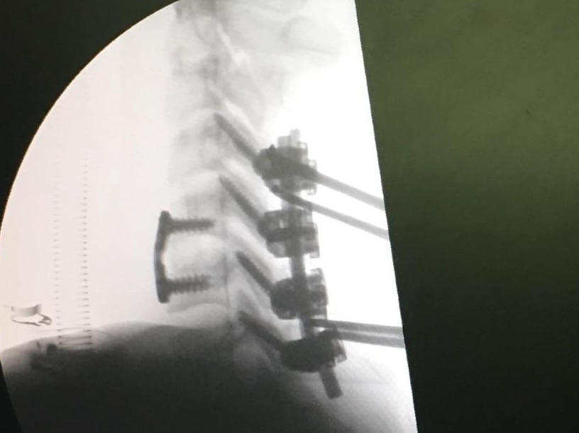 Ollie's first operation inserted a plate and four screws while his second operation inserted two rods and eight screws.