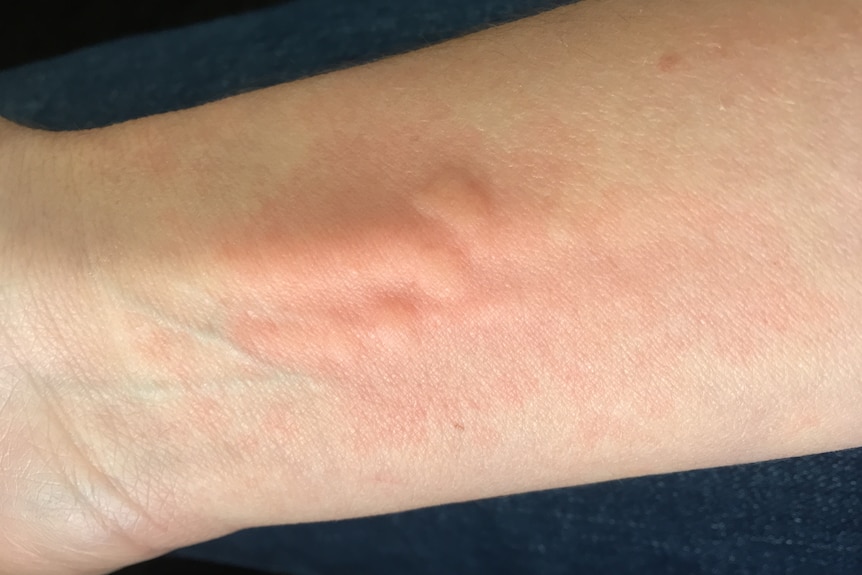 A forearm with large painful looking raised bumps on it.